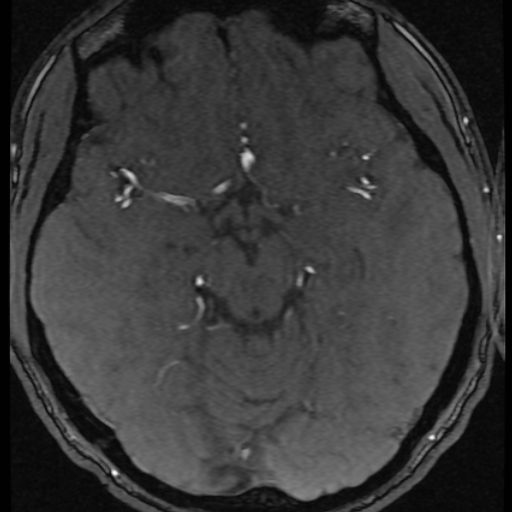 Azygos anterior cerebral artery (Radiopaedia 17059-16756 Axial MRA 37).jpg