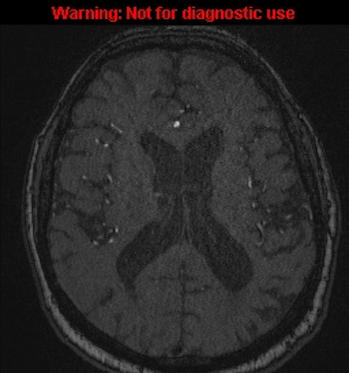 Azygos anterior cerebral artery (Radiopaedia 59325-66677 Axial MRA 104).jpg