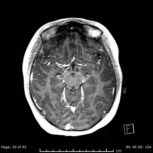 Balo concentric sclerosis (Radiopaedia 61637-69636 Axial T1 C+ 29).jpg