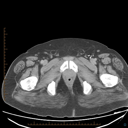File:Bariatric balloon causing gastric outlet obstruction (Radiopaedia 54449-60672 A 45).jpg