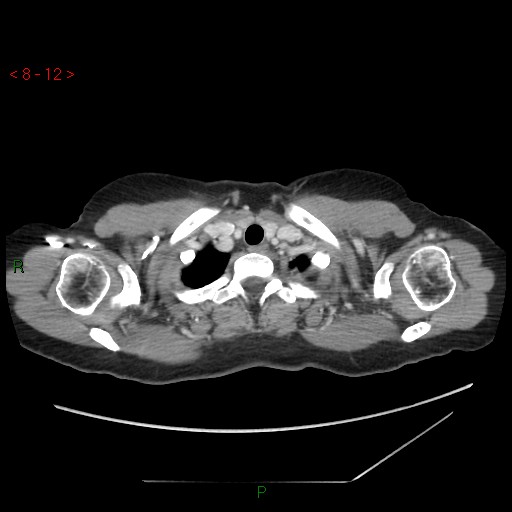 Bartholin gland cyst (Radiopaedia 54904-61181 A 3).jpg