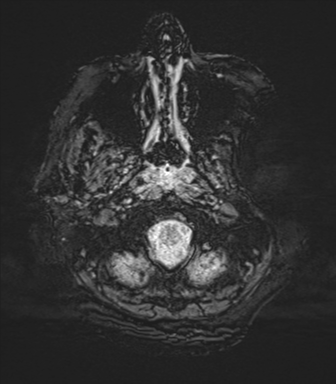 Basal ganglia metastasis (Radiopaedia 78928-91828 Axial SWI 4).png