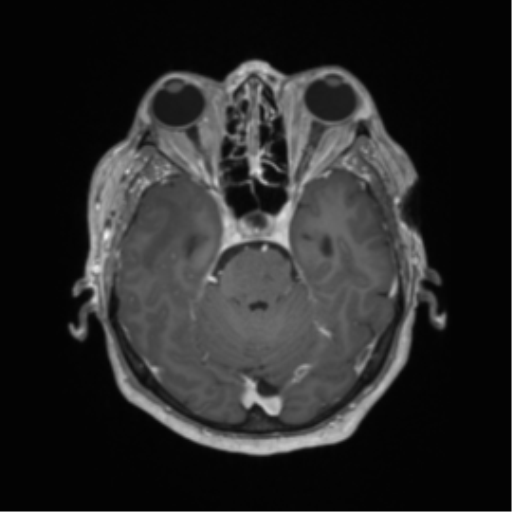 Basal ganglia metastasis (Radiopaedia 78928-91828 Axial T1 C+ 22).png