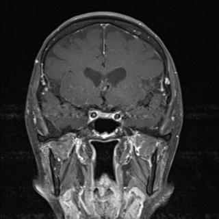 File:Base of skull chondrosarcoma (Radiopaedia 30410-31070 G 3).jpg