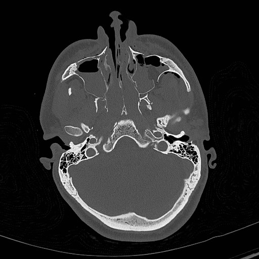 Base of skull fracture with bilateral Le Fort fractures (Radiopaedia 47094-51638 Axial bone window 26).jpg