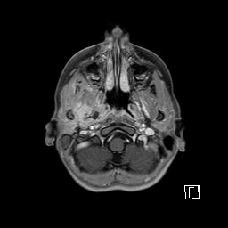 Base of skull rhabdomyosarcoma (Radiopaedia 32196-33142 T1 C+ fat sat 23).jpg
