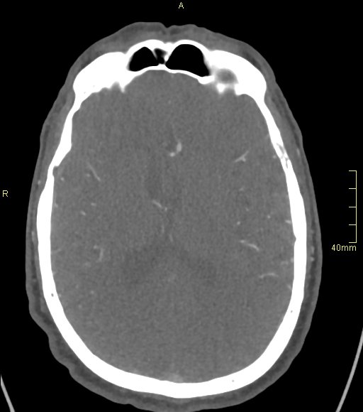 Basilar artery aneurysm (Radiopaedia 56261-62932 A 88).jpg