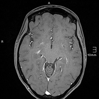 Basilar artery perforator aneurysm (Radiopaedia 82455-99523 G 66).jpg