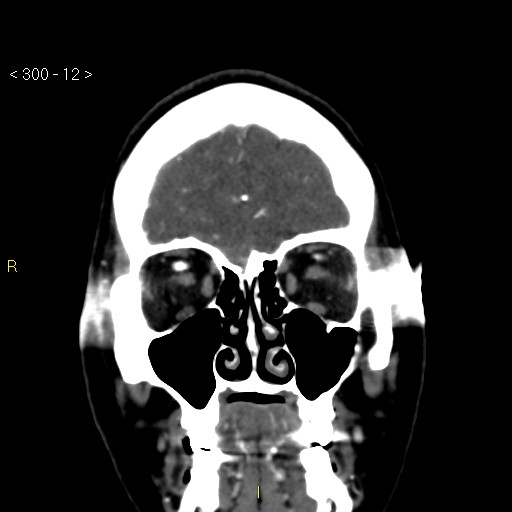 File:Basilar artery thrombosis (Radiopaedia 16260-15944 B 3).jpg