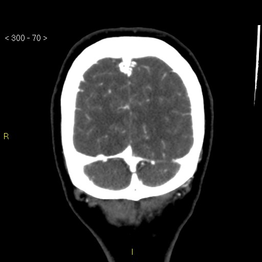 Basilar artery thrombosis (Radiopaedia 16260-15944 B 61).jpg