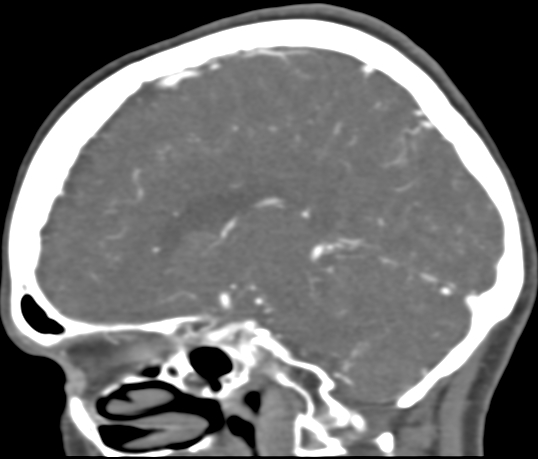 Basilar tip aneurysm with coiling (Radiopaedia 53912-60086 C 77).jpg