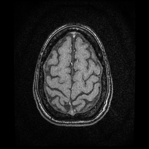 Basilar top and left middle cerebral artery aneurysm (Radiopaedia 61965-70031 Axial MRA 150).jpg