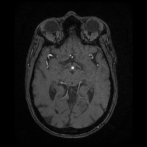 Basilar top and left middle cerebral artery aneurysm (Radiopaedia 61965-70031 Axial MRA 71).jpg