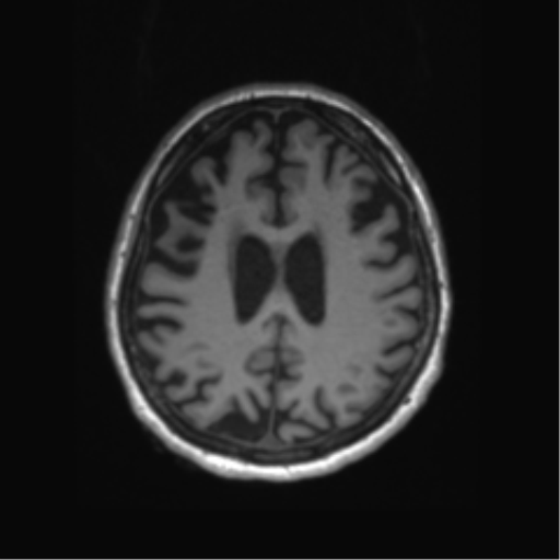 Behavioral variant frontotemporal dementia and late onset schizophrenia (Radiopaedia 52197-58083 Axial T1 28).png