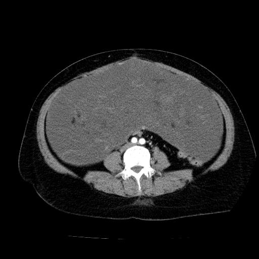 Benign spindle cell tumor - abdominopelvic (Radiopaedia 61300-69212 A 37).jpg