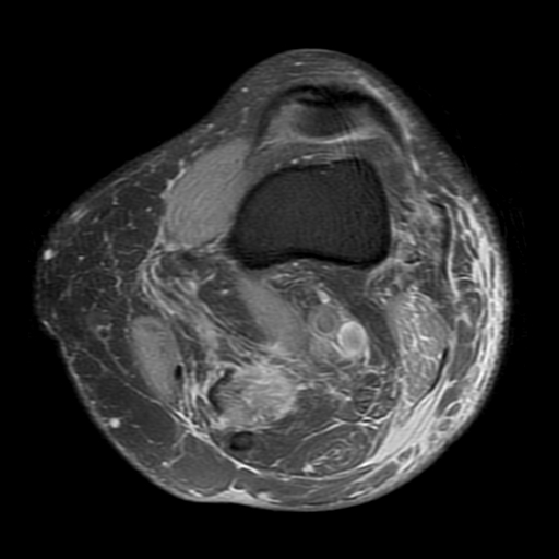 File:Biceps femoris distal tendon avulsion (Radiopaedia 15109-14987 Axial PD fat sat 3).jpg