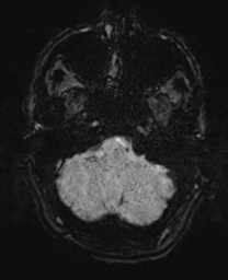 Bifrontal leucotomy (Radiopaedia 36798-38385 Axial SWI 10).png
