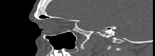 Bilateral Ectopic Infraorbital Nerves (Radiopaedia 49006-54084 Sagittal bone window 38).jpg