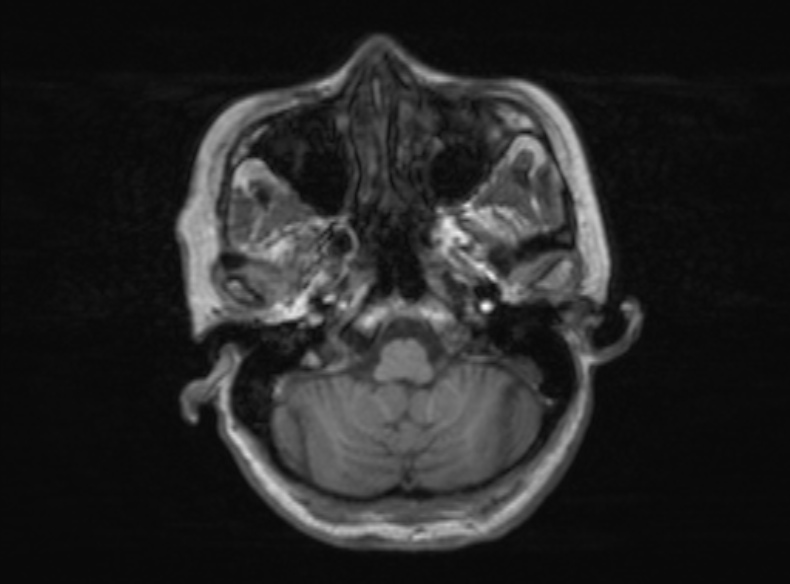 File:Bilateral PCA territory infarction - different ages (Radiopaedia 46200-51784 Axial T1 323).jpg