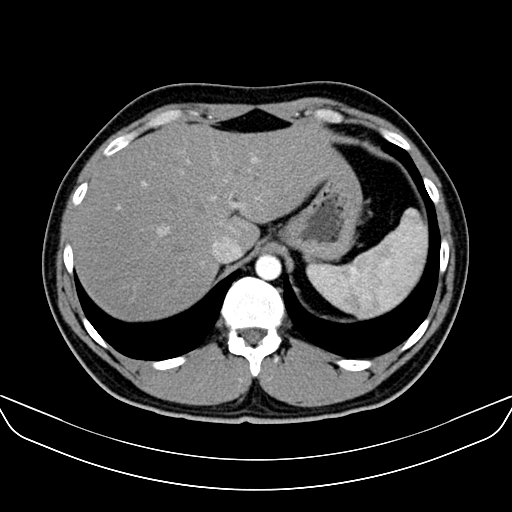 Bilateral accessory renal arteries with mild pelvi-ureteric junction (PUJ) obstruction (Radiopaedia 66357-75596 A 6).jpg
