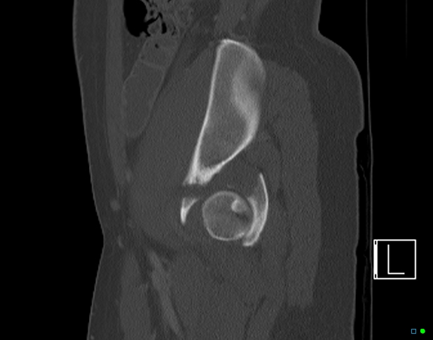 Bilateral acetabular fractures (Radiopaedia 79272-92308 Sagittal bone window 67).jpg