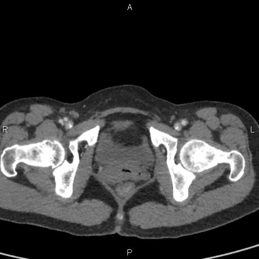 Bilateral adrenal gland hyperenhancement in pancreatitis (Radiopaedia 86642-102753 E 108).jpg