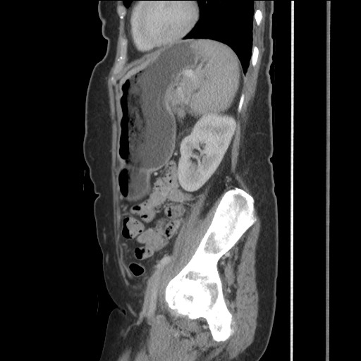 File:Bilateral adrenal granulocytic sarcomas (chloromas) (Radiopaedia 78375-91007 C 99).jpg