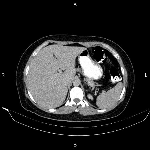 Bilateral adrenal myelolipoma (Radiopaedia 63058-71535 Axial C+ delayed 16).jpg