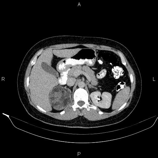 Bilateral adrenal myelolipoma (Radiopaedia 63058-71535 Axial C+ delayed 30).jpg
