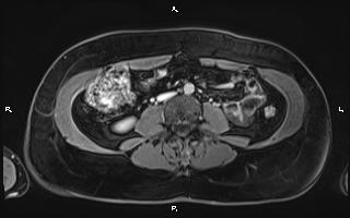 File:Bilateral adrenal myelolipoma (Radiopaedia 63058-71537 H 67).jpg