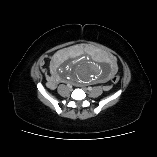 Bilateral adrenal thrombosis (Radiopaedia 58182-65256 A 53).jpg