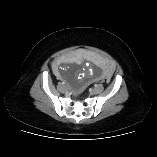 Bilateral adrenal thrombosis (Radiopaedia 58182-65256 A 60).jpg