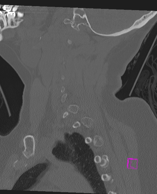 Bilateral atlanto-occipital assimilation (Radiopaedia 28350-28603 Sagittal bone window 22).jpg