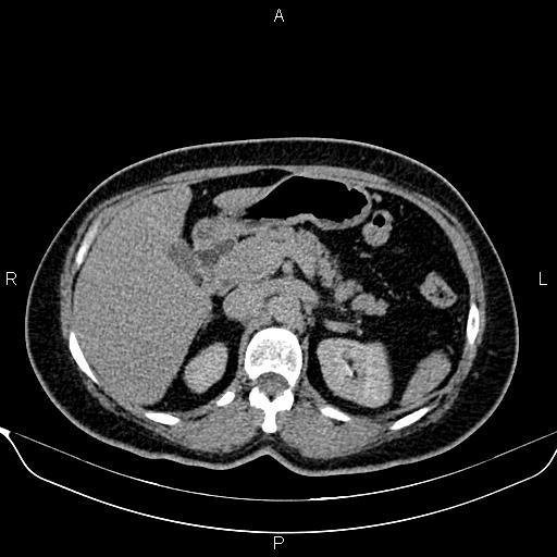 Bilateral benign adrenal adenomas (Radiopaedia 86912-103124 Axial C+ delayed 39).jpg