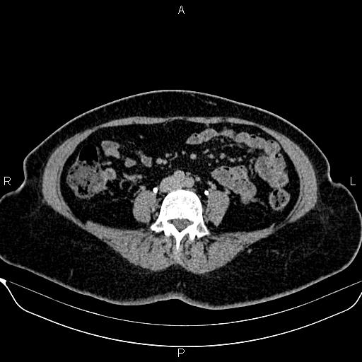 Bilateral benign adrenal adenomas (Radiopaedia 86912-103124 Axial C+ delayed 95).jpg