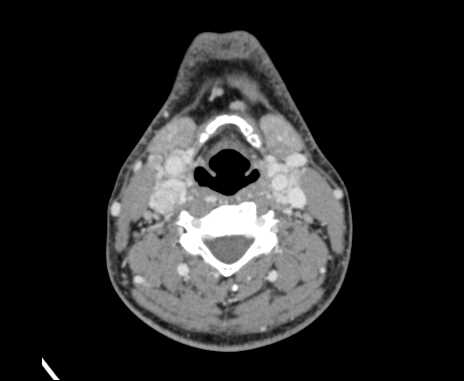 File:Bilateral carotid body tumors (Radiopaedia 61841-69870 Axial Post contrast 58).jpg