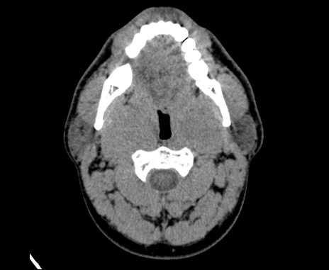 Bilateral carotid body tumors (Radiopaedia 61841-69870 Axial non-contrast 32).jpg