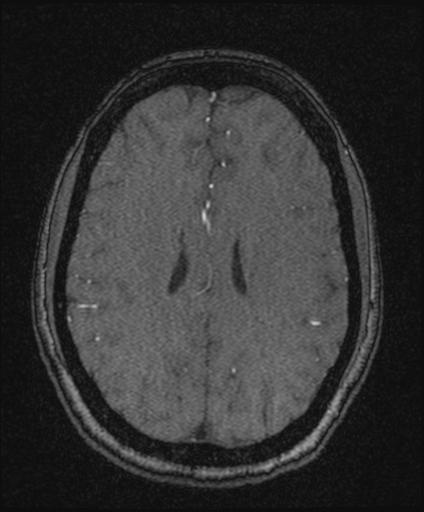 Bilateral carotid body tumors and right glomus jugulare tumor (Radiopaedia 20024-20060 Axial MRA 122).jpg