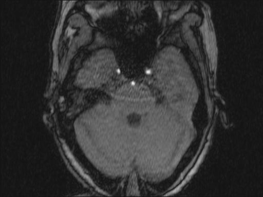 Bilateral carotid body tumors and right glomus jugulare tumor (Radiopaedia 20024-20060 Axial MRA 324).jpg