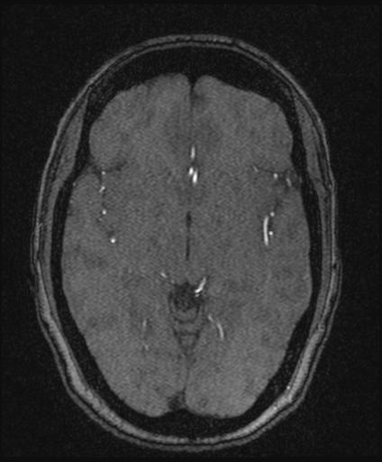 Bilateral carotid body tumors and right glomus jugulare tumor (Radiopaedia 20024-20060 Axial MRA 88).jpg