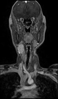 Bilateral carotid body tumors and right glomus jugulare tumor (Radiopaedia 20024-20060 MRA 12).jpg