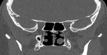 File:Bilateral ectopic infraorbital nerves (Radiopaedia 49006-54084 Coronal 5).png