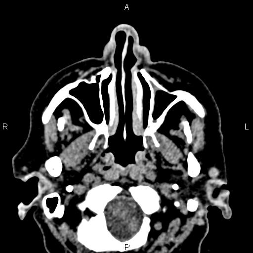 Bilateral enlargement of lacrimal glands - sarcoidosis (Radiopaedia 62627-70921 Axial non-contrast 4).jpg