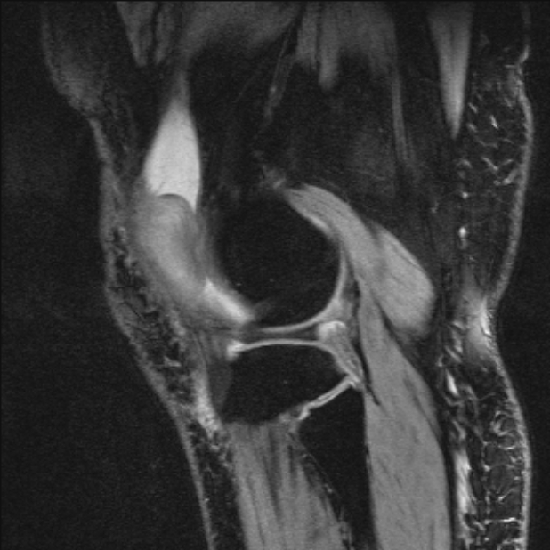 Bilateral focal pigmented villonodular synovitis (Radiopaedia 67643-77046 G 52).jpg