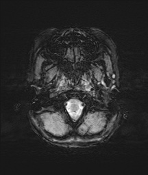 Bilateral mesial temporal polymicrogyria (Radiopaedia 76456-88181 Axial SWI 2).jpg
