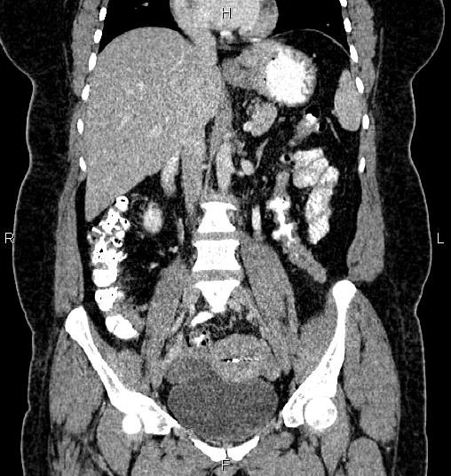 Bilateral ovarian dermoid cysts (Radiopaedia 85785-101603 C 27).jpg