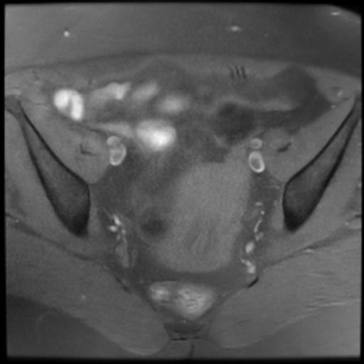 File:Bilateral ovarian dermoid cysts (Radiopaedia 90152-107338 Axial T1 fat sat 11).jpg