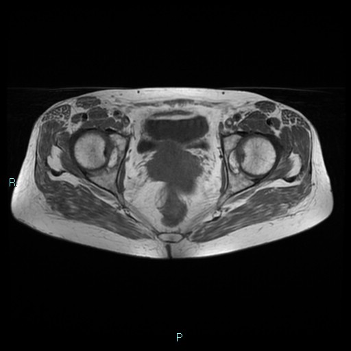 File:Bilateral ovarian fibroma (Radiopaedia 44568-48293 Axial T1 20).jpg