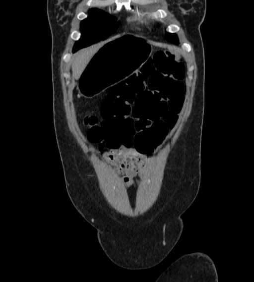 Bilateral ovarian mature cystic teratomas (Radiopaedia 79373-92457 B 5).jpg