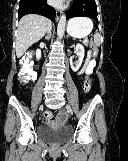 Bilateral ovarian serous cystadenocarcinoma (Radiopaedia 86062-101989 D 28).jpg